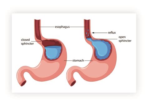 Schematické znázornenie pažeráka a žalúdka s vyznačením dolného pažerákového zvierača.