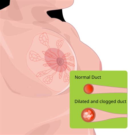 Schéma znázorňujúca upchatý mliekovod v prsníku