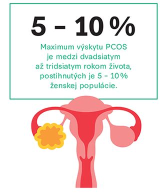 Infografika zobrazujúca syndróm polycystických ovárií (PCOS)