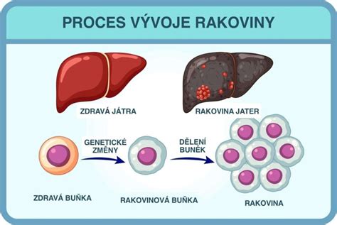 Infografika vysvetľujúca proces vzniku a odbúravania bilirubínu
