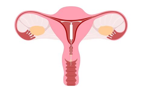 ilustračná fotografia znázorňujúca ženu s vnútromaternicovým telieskom Mirena