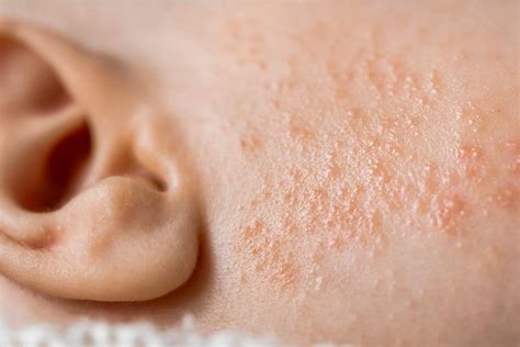 Ilustrácia rôznych detských kožných problémov (akné, potničky, zaparenie).