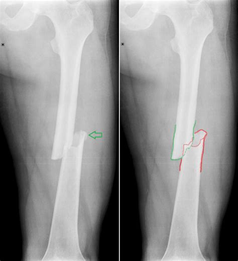 Rentgenový snímok detskej zlomeniny.