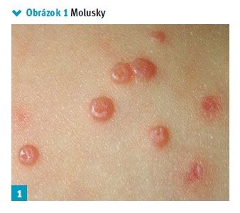 Ilustrácia molusiek na koži