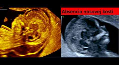 Anatomické zobrazenie plodu počas morfologického ultrazvuku