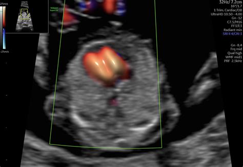Detailný záber ultrazvukového obrazu plodu, zameraný na srdce