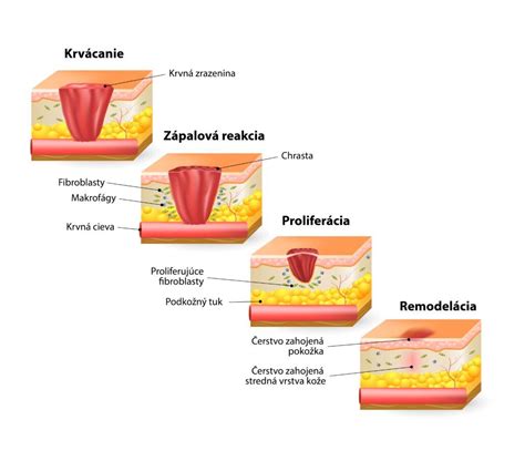 Infografika znázorňujúca proces hojenia jazvy po cisárskom reze
