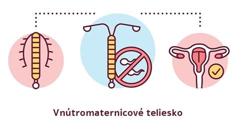 schematické znázornenie vnútromaternicového telieska v maternici