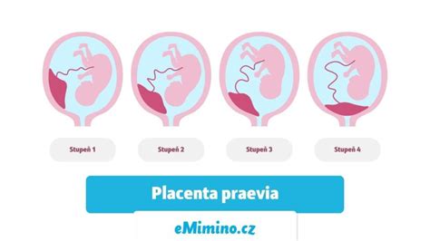 Ilustrácia znázorňujúca polohu placenty pri rôznych typoch placenty praevia (úplná, čiastočná, okrajová, nízko položená)