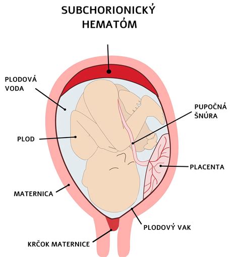 ilustrácia znázorňujúca subchoriálny hematóm v maternici