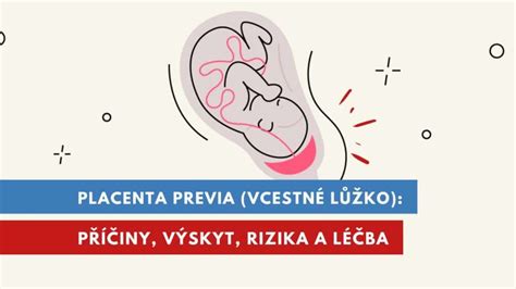 Grafické znázornenie, ako predná placenta môže tlmiť pohyby plodu.