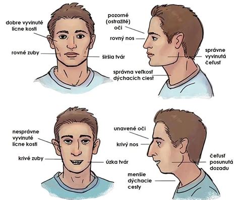 Porovnanie tváre dieťaťa, ktoré dýcha nosom, a dieťaťa, ktoré dýcha ústami.
