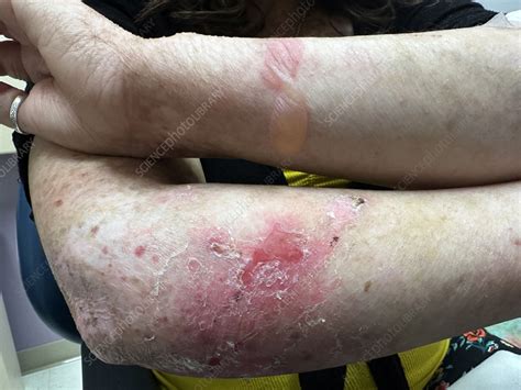 Ilustračná fotografia pacienta s Epidermolysis Bullosa, zobrazujúca postihnutú kožu.