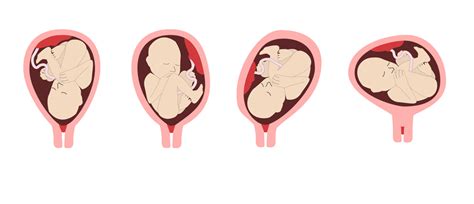 Schéma zobrazujúca rôzne polohy plodu v maternici, vrátane konca panvového