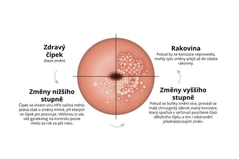 Ilustrácia zobrazujúca rôzne stupne naliehania hlavičky plodu ku krčku maternice
