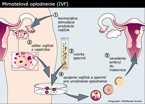 Grafické znázornenie rôznych metód asistovanej reprodukcie.