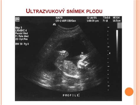 ultrazvukový snímok plodu s vyznačenou nuchálnou oblasťou