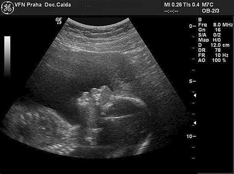 Ilustračná fotografia ultrazvuku plodu