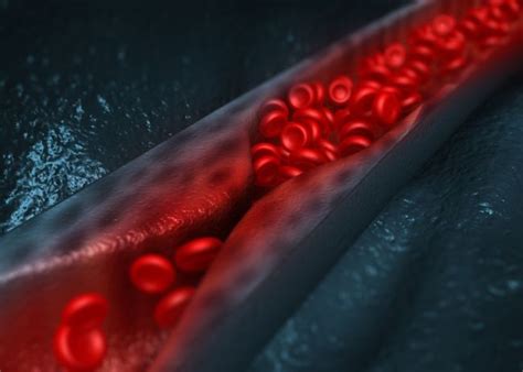 Ilustračná schéma znázorňujúca riziko vzniku krvnej zrazeniny a embólie.