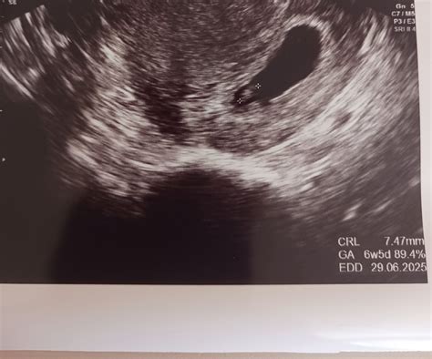 ultrazvukové zobrazenie embrya v 7. týždni tehotenstva