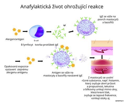 Ilustračná schéma anafylaktického šoku so zobrazenými príznakmi