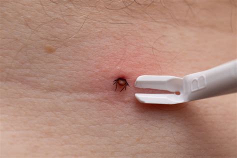 Návod na správne odstránenie kliešťa pomocou pinzety