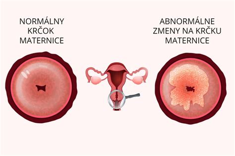 Zobrazenie zmien krčka maternice v priebehu menštruačného cyklu.