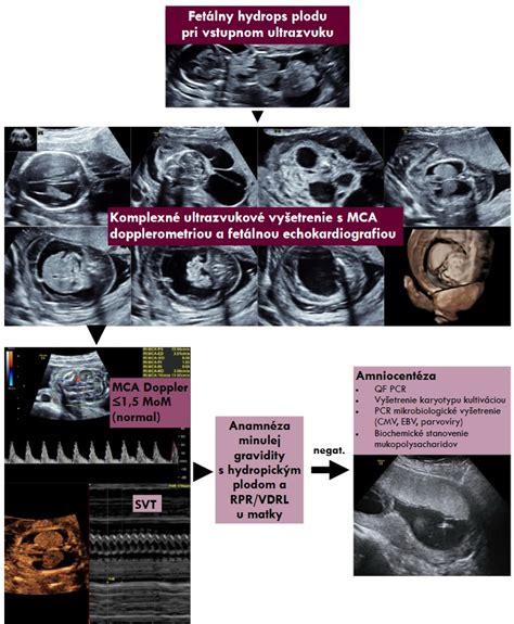 Schéma transvaginálneho ultrazvukového vyšetrenia