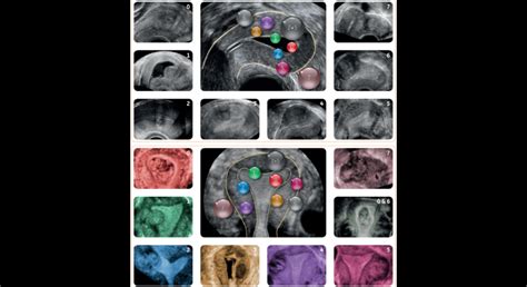 Vizualizácia dutiny maternice s kontrastným médiom