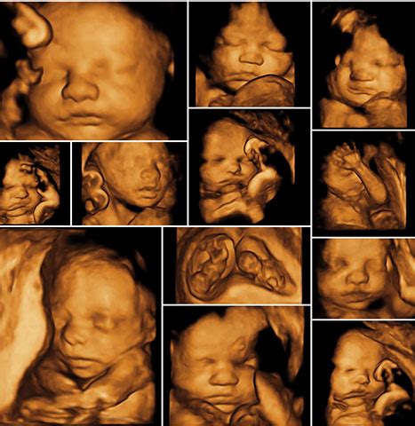 3D ultrazvuk plodu v druhom trimestri