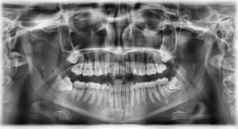 Röntgenový snímok zubov s vyznačenými kazmi a možnými zápalovými procesmi.