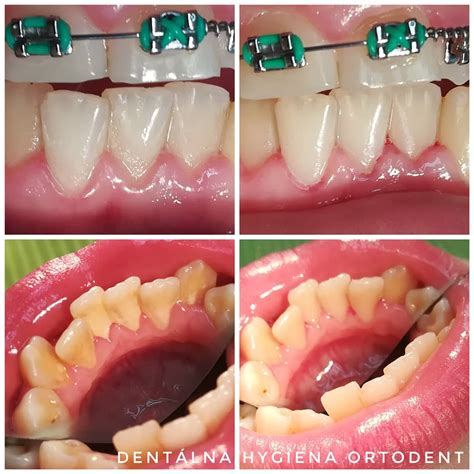 ilustrácia zobrazujúca proces ustupovania ďasien a obnaženie zubného koreňa