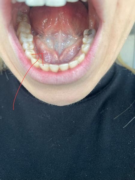 Ilustrácia anatomického umiestnenia uzdičky pod jazykom