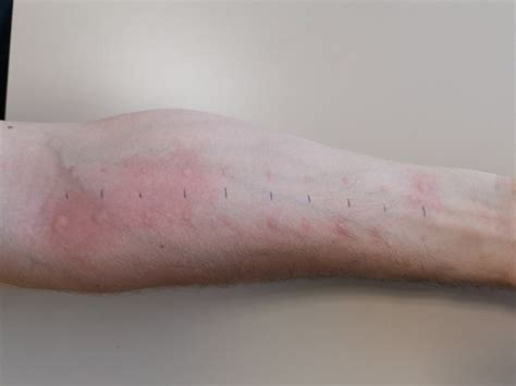 Lekár vykonáva kožný alergický test na predlaktí dieťaťa.