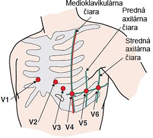 Ilustrácia znázorňujúca umiestnenie elektród a slúchadiel pri AABR vyšetrení.