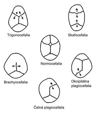 Ilustrácia zobrazujúca rôzne typy deformácií lebky u dojčiat: plagiocefália, brachycefália, dolichocefália.