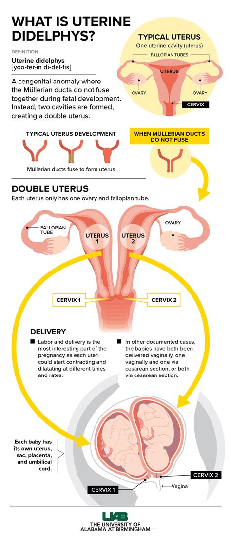 Ilustrácia dvojitej maternice (uterus didelphys)