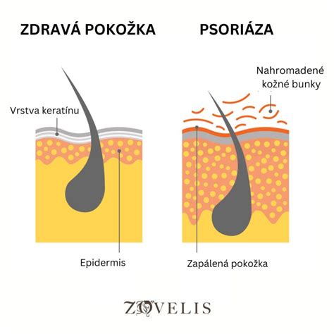 Ilustrácia ochrannej bariéry vytvorenej zinkovou masťou na pokožke