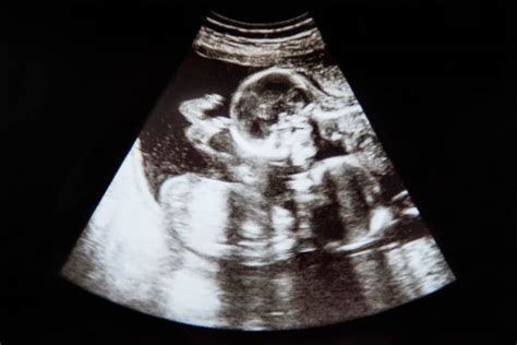 Sonografický snímok plodu v 20. týždni tehotenstva s detailným zobrazením orgánov.