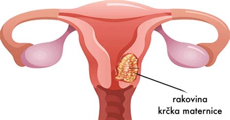 grafické znázornenie možných príznakov ruptúry maternice