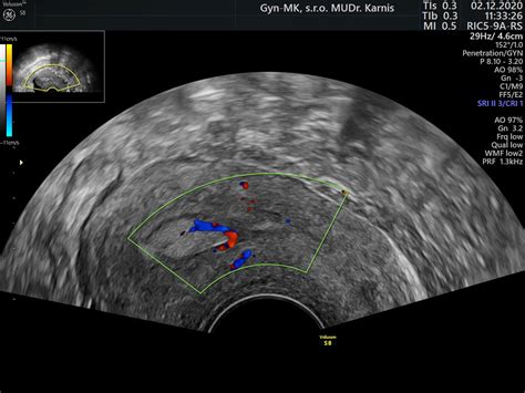 Schematické znázornenie ultrazvukového vyšetrenia maternice a endometria