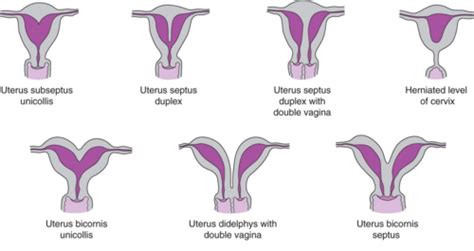 Ilustrácia rôznych typov anomálií maternice (uterus didelphys, uterus bicornis, uterus septus, uterus arcuatus)