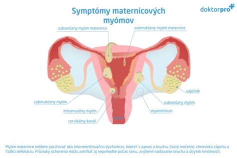 Schematické znázornenie rôznych typov myómov maternice (subserózny, intramurálny, submukózny)