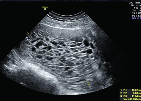 Ultrazvukový snímok znázorňujúci mola hydatidosa
