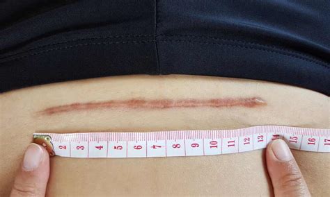 Ilustračná fotografia jazvy po cisárskom reze