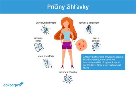 grafické znázornenie rôznych spúšťačov žihľavky (potraviny, lieky, fyzikálne faktory, stres)