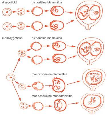 Infografika znázorňujúca rôzne typy dvojčiat (jednovaječné/dvojvaječné, monochoriálne/bichoriálne, monoamniálne/biamniálne)
