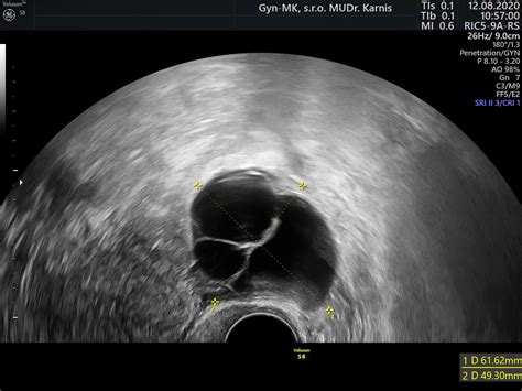 Ultrazvukový snímok vaječníka s rastúcimi folikulmi