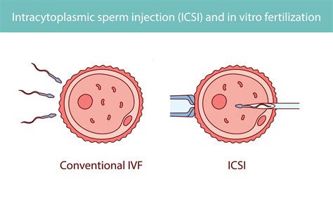 Schéma procesu IVF a ICSI