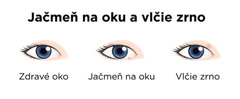 infografika zobrazujúca rozdiely v UV žiarení dopadajúcom na detské a dospelé oči